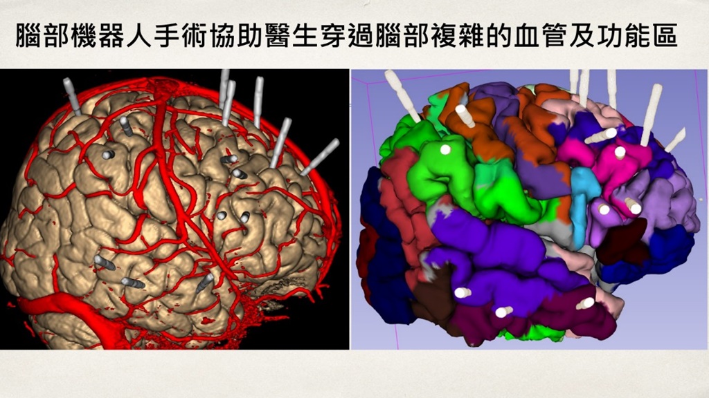腦部複雜血管