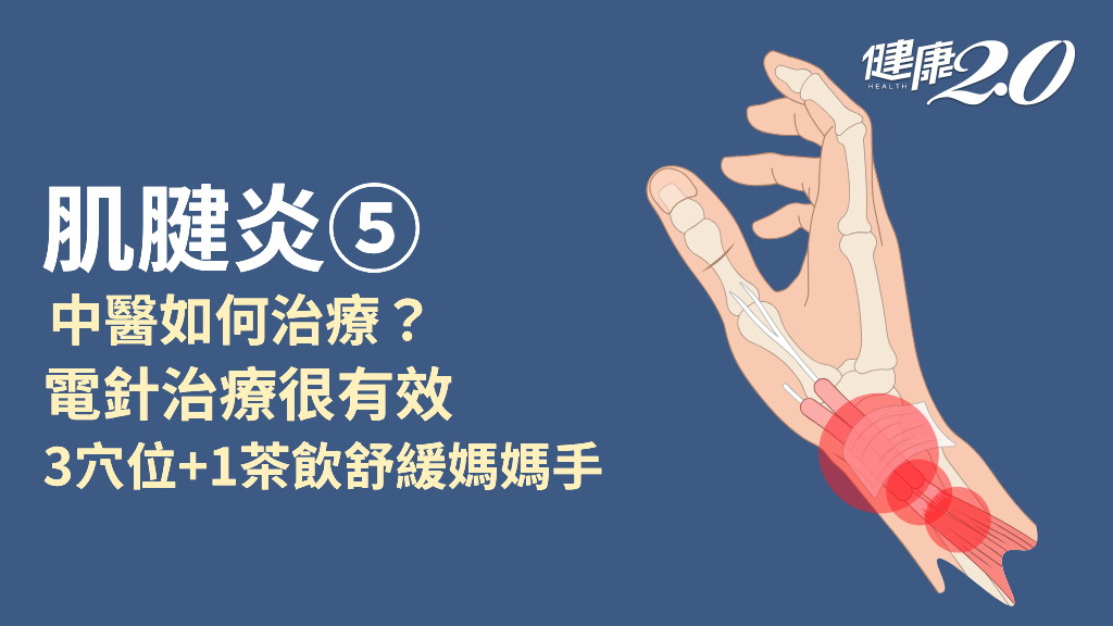 肌腱炎／中醫如何治療肌腱炎？針灸治療有效嗎？3穴位、1茶飲舒緩肌腱炎