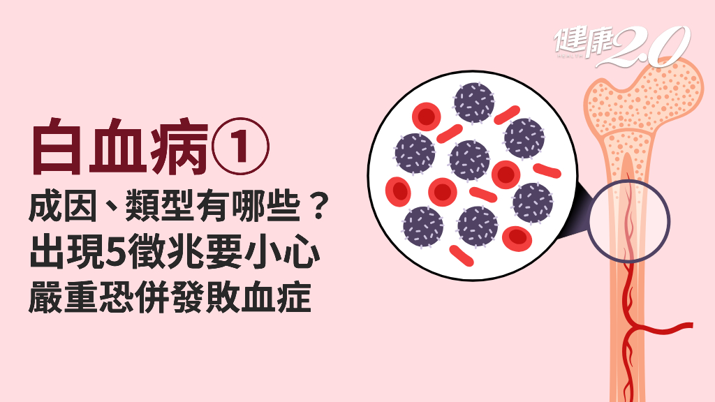 白血病／白血病=血癌？成因複雜 輻射汙染<span style="color:#1BA42B;">致病率</span>高！4種類型、症狀看過來