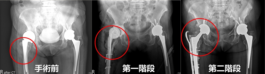 關節分階段再置換