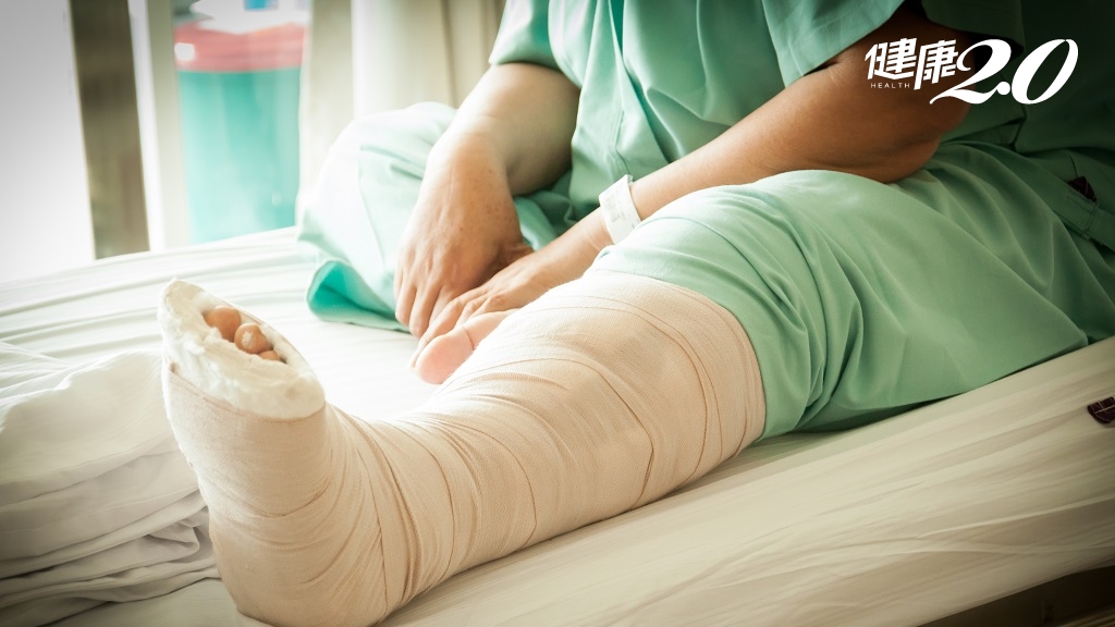 骨折吃什麼較快好？骨頭何時長好？錯過復健黃金期會增加二次跌倒、扭傷機率