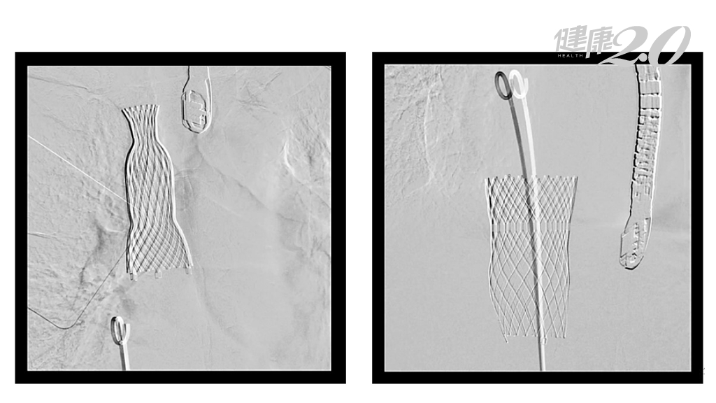 年紀大不堪開心手術 新醫材「幫心臟加2個瓣膜」救高齡心衰竭 台大醫院創亞洲首例
