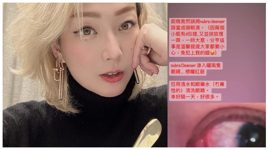 鄭秀文眼睛出狀況冒血絲！原來卸妝油用錯了 眼睛急救這樣做