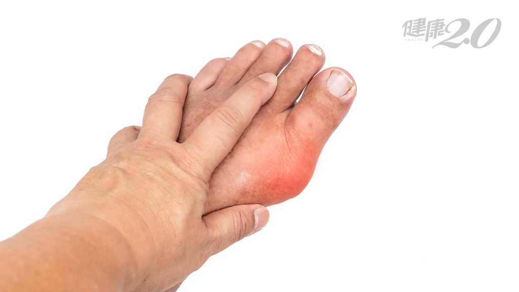 關節沒腫卻摸出這種東西 小心痛風悄悄找上你