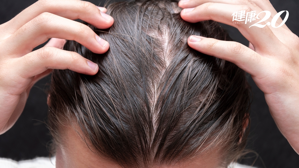 夏日頭皮控油 什麼症狀用哪種洗髮精？皮膚科醫師這樣挑