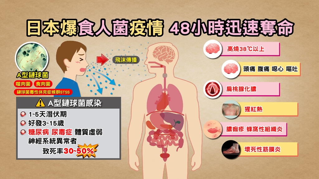 食人菌透過飛沫傳染 醫示警：感染拖越久才治療死亡風險高
