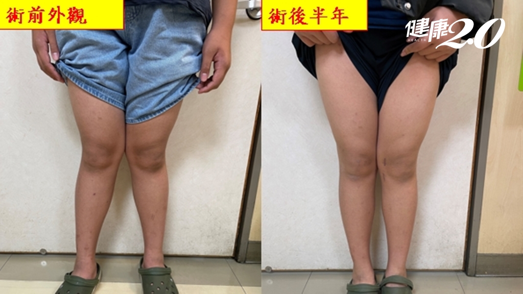 Ｘ型腿少年跑步膝蓋互撞 醫勸這歲數前治療效果好/medical/349178