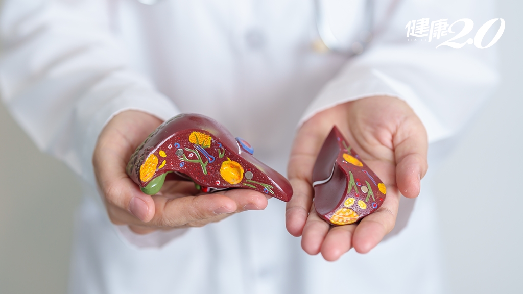 脂肪肝竟須換肝！他脂肪肝沒在管變肝硬化吐血 肝縮水剩1/3只能換肝續命