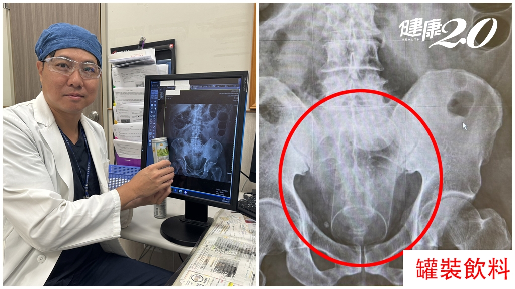尋刺激？男稱腹痛3天無法排便 醫照X光驚見飲料罐塞進肛門