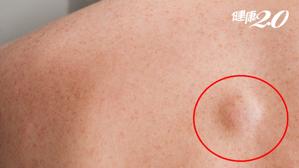 這些位置要注意！摸起來圓圓的無痛不癢「腫塊」 形成原因竟和體質有關