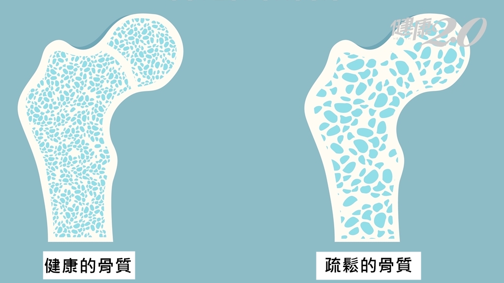 糖尿病易骨鬆？醫勸做好「這些事」不用擔心
