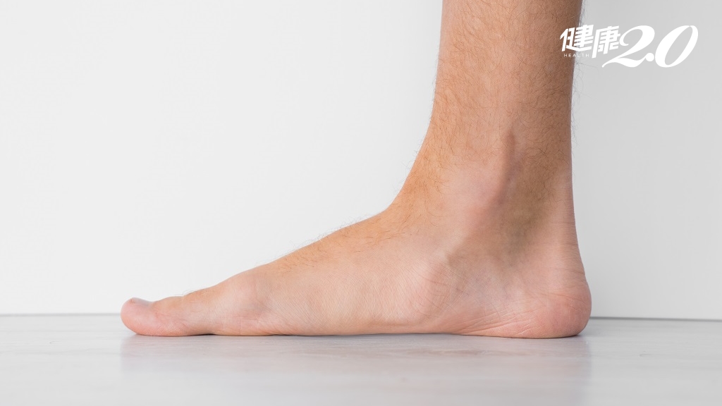 腳痛、扭傷不能拖！60歲奶奶慘「足弓消失」變後天性扁平足 醫曝4大危險因子