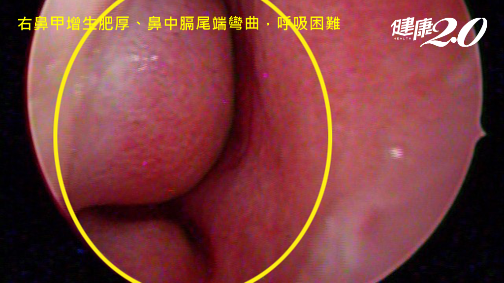 鼻塞塞成睡覺缺氧恐成心血管疾病！醫勸「這歲數以上」鼻塞最好做檢查
