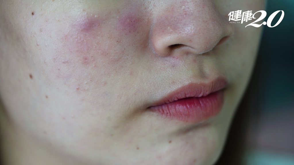 她飽受10多年痘痘困擾，竟是這隱藏病因！吃辣等4大誘因曝光