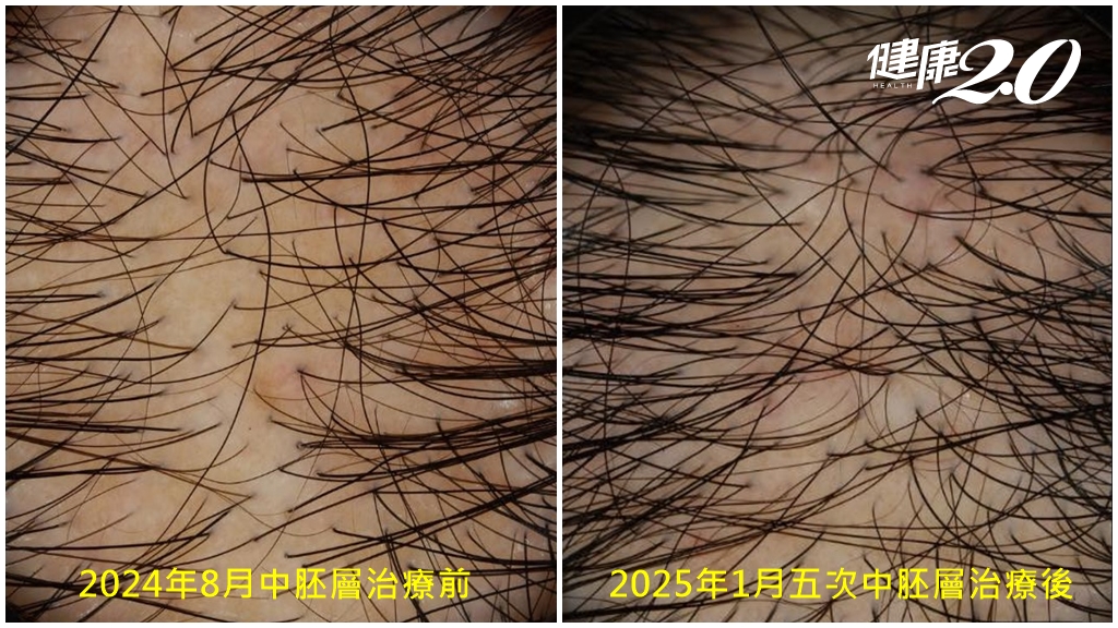 頭髮稀疏怎麼辦？新療法雙管齊下 藥物劑量、副作用雙降