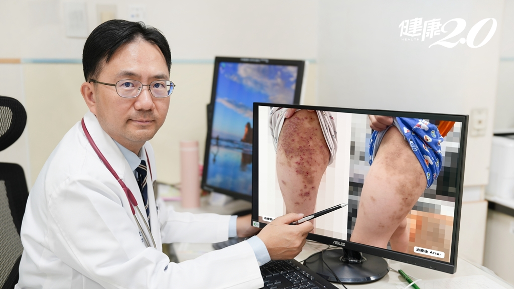 男童皮膚癢到睡不著、不敢上學 醫推2方法明顯改善異位性皮膚炎