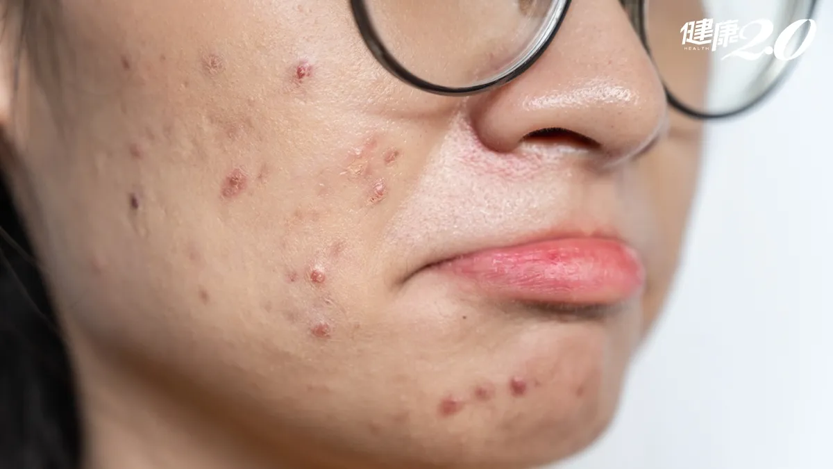 亂擦A醇、A醛當心臉爛！「這種膚質」擦了恐脫皮、發紅/medical/354024