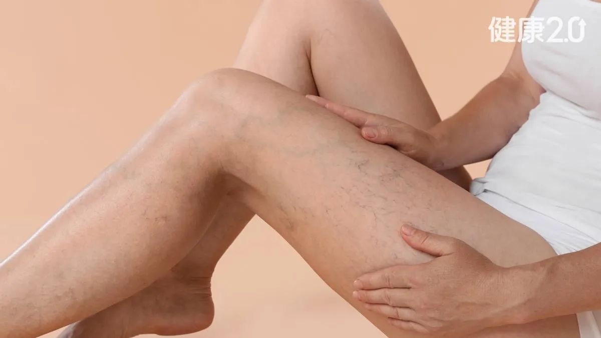 <span style="color:#1BA42B;">腿上有血絲</span>冒青筋就是靜脈曲張？90%的人都搞錯！誤判小心「爛腿」