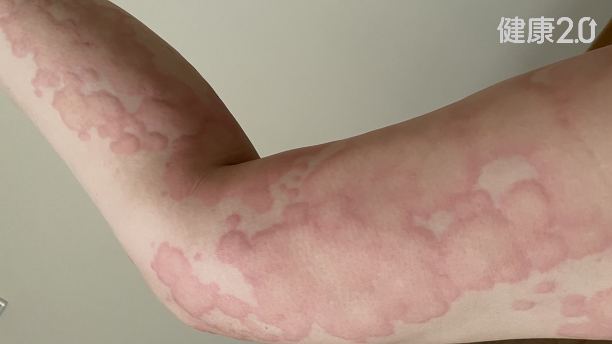 不是食物過敏！她慢性蕁麻疹呼吸困難險喪命 1招自測蕁麻疹體質