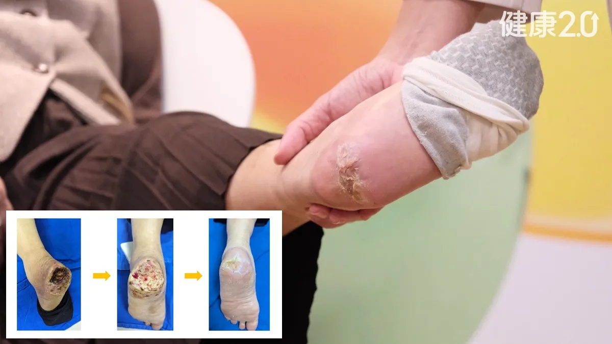 她糖尿病足傷口「半顆棒球大」 再生醫療助2個月康復免截肢