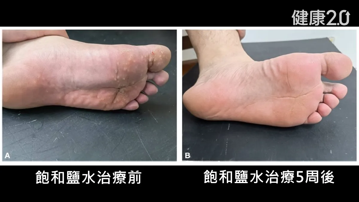 鹽水泡腳治足底疣！研究揭無痛療法 泡8周98%成功零復發/medical/359597