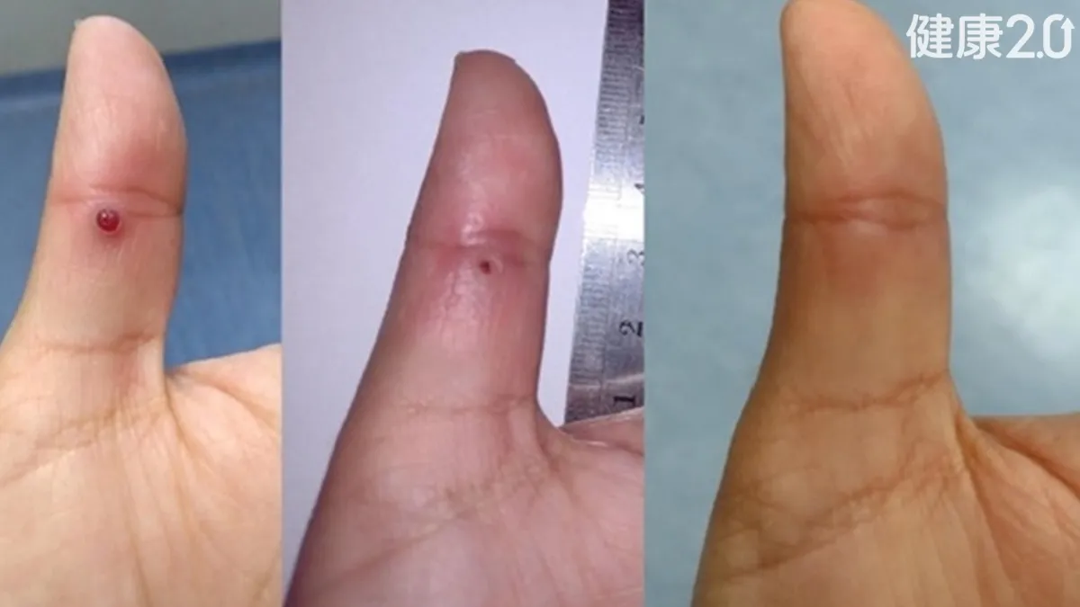 血管肉芽一碰就流血？鹽巴竟能治！台大醫揭神效：滿意度91%/medical/359306