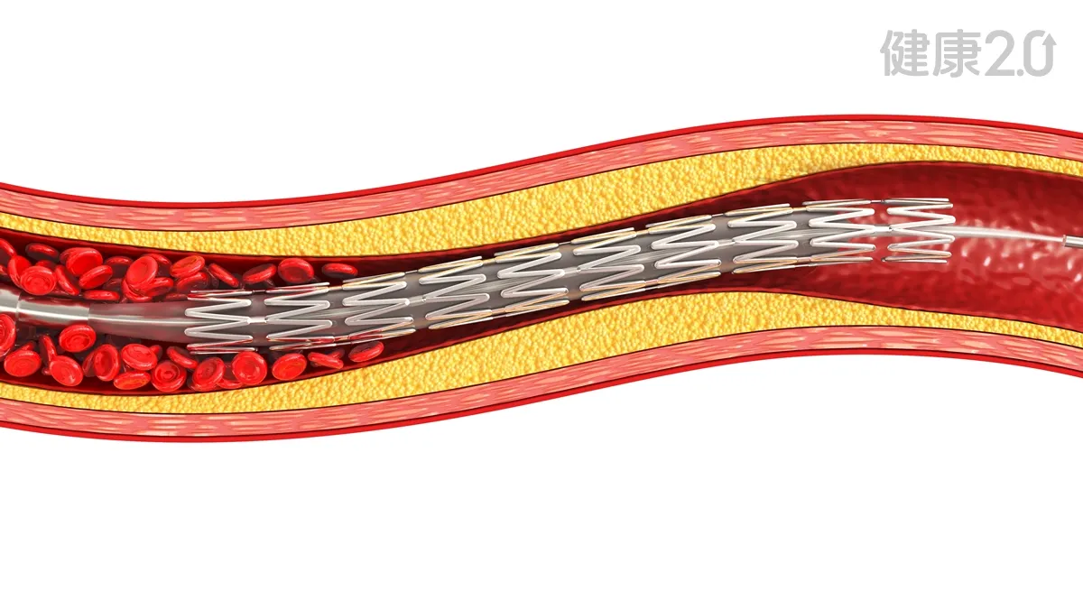 裝支架不是一勞永逸！4種人「這些事」沒做好心肌梗塞風險高