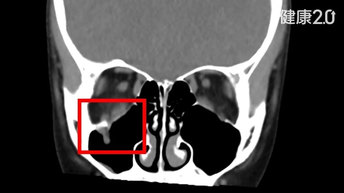 女童眼眶骨折眼球動不了、看東西有影子！外觀沒黑青腫脹易忽略