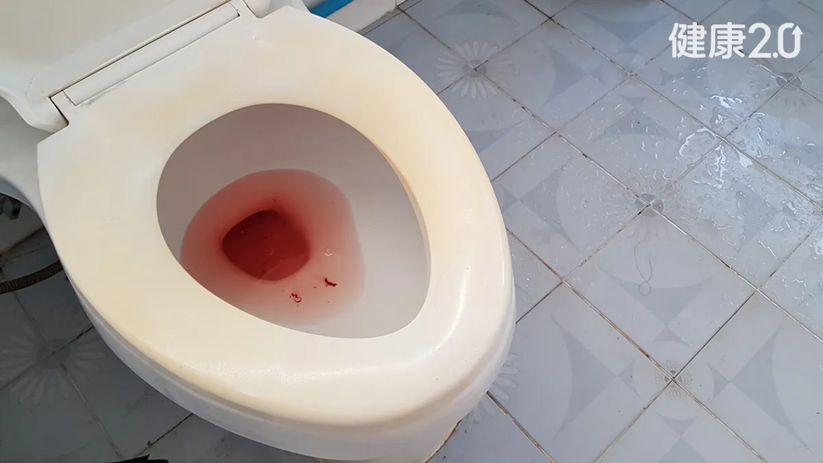 血尿不痛更危險！6旬婦原以為小毛病 檢查竟是輸尿管癌