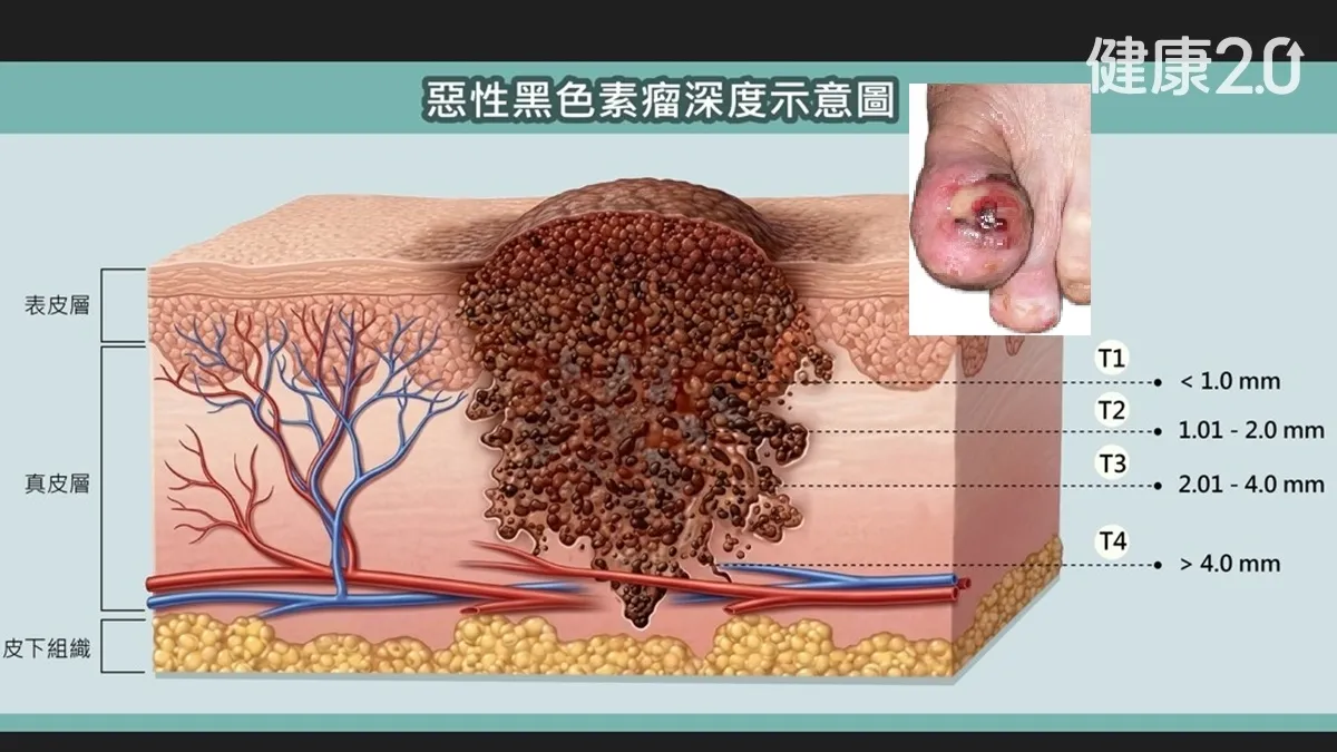 腳趾黑點、傷口不癒要小心！婦截趾保命 手腳皮膚5變化恐是惡<span style="color:#1BA42B;">性</span>癌