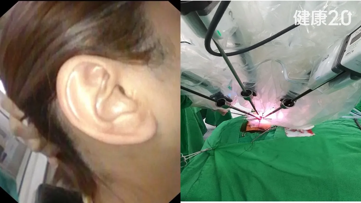 耳下腫塊竟是腫瘤！網紅香蕉太太腮腺腫瘤6年不敢開刀 微創手術治好鼓舞好多人