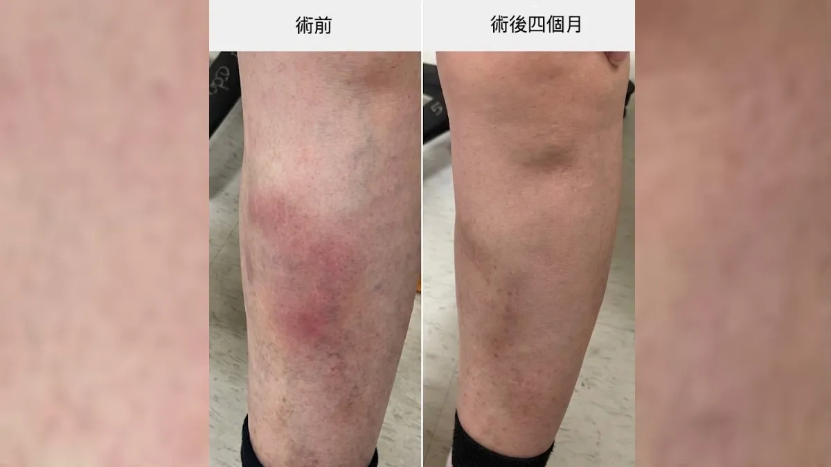 靜脈曲張不會痛不用管?70歲婦突發病痛到不能走!醫:血栓風險高5.3倍恐致命
