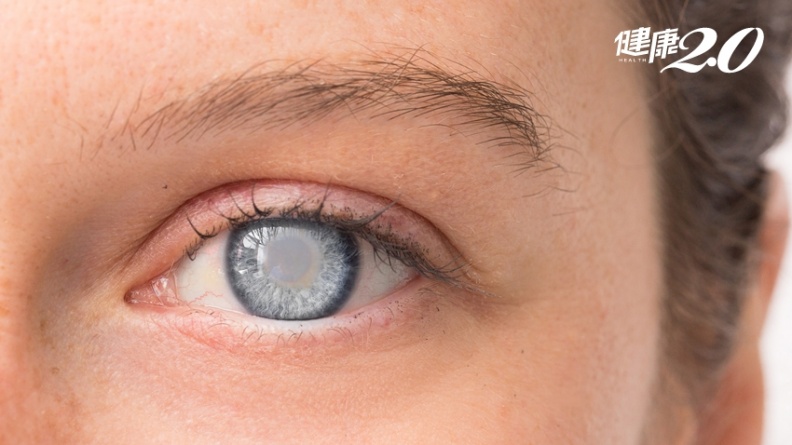 40歲有白內障  「白目危險因子」你中了幾項？