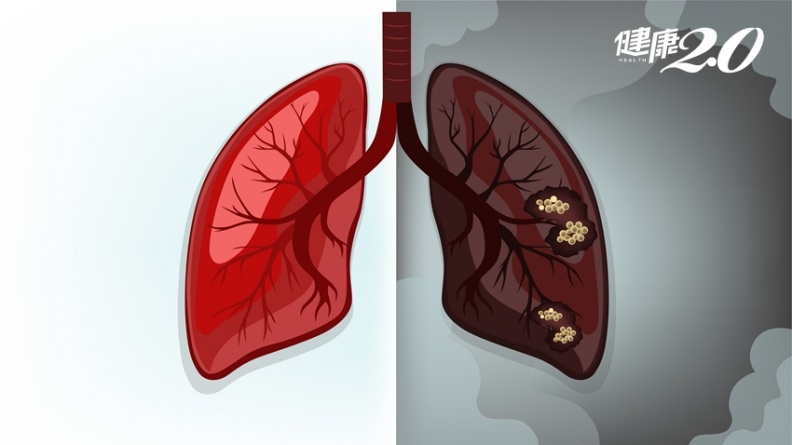 晚期肺癌莫絕望！「三代組合療法」突破治療困境，死亡風險降2成
