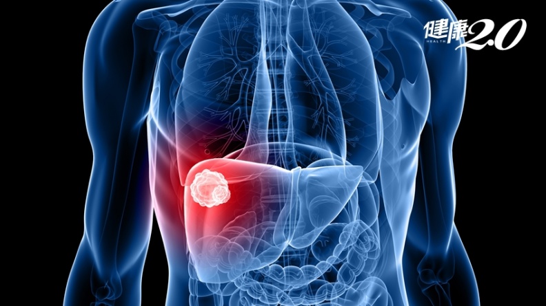 不菸不酒怎麼會罹患肝癌？醫師曝2原因才最危險