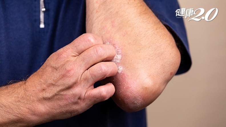 皮膚越癢越想抓！罹異位性皮膚炎小心患憂鬱症、<span style="color:#1BA42B;">失明</span> 出現2徵兆速就醫勿拖延