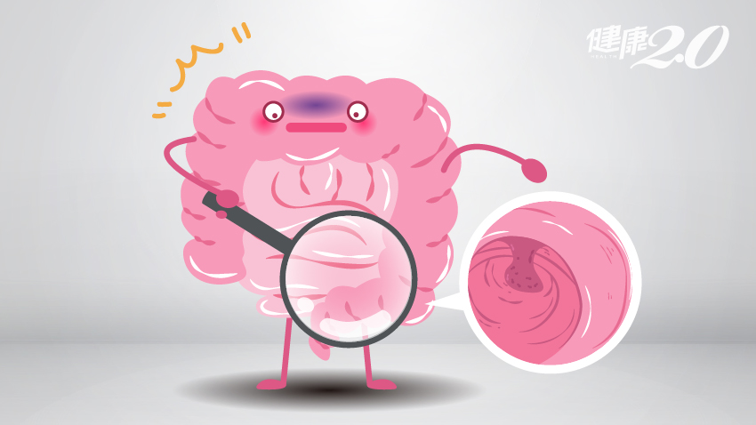 大腸息肉不切除，10年後會變成癌症？