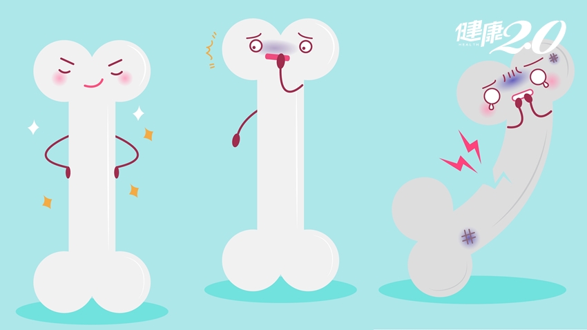 1分鐘揪出骨折危機：骨鬆找上我了嗎？