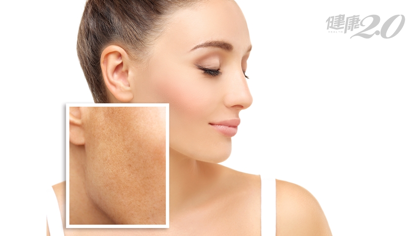 臉上掛豬肝？惱人的肝斑怎麼治 醫師提醒一個大重點
