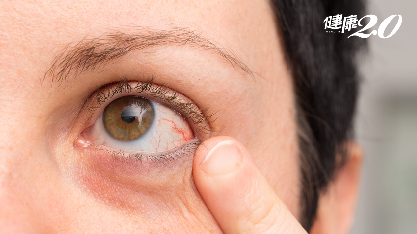 眼睛發炎<span style="color:#1BA42B;">失明</span>，竟是關節炎搞鬼！哪些全身性疾病會導致眼病？