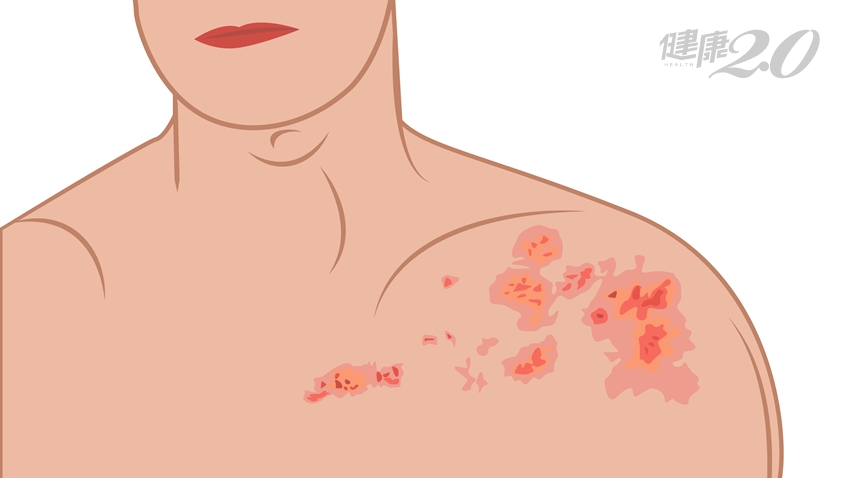 預防皮蛇上身，打疫苗有效？醫師建議這些人要施打