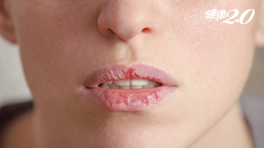 別讓嘴唇乾到流血…保養步驟「2不1要」快記牢！