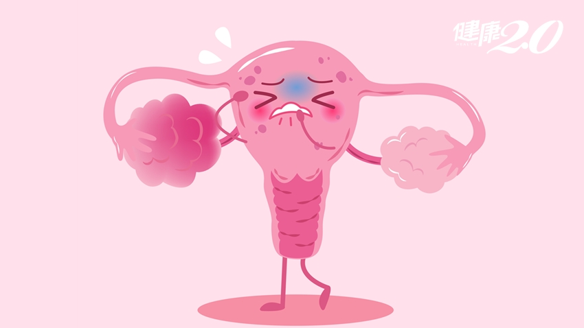 「多囊性卵巢」潛藏婦癌隱憂！注意這些症狀 用「鎂鉀」逆轉