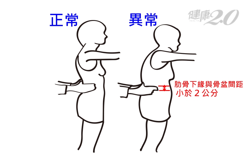骨鬆異常 - 骨鬆異常.jpg