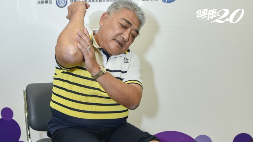 他乾癬共處35年！關節炎讓他痛到徹夜難眠 6月起健保給付新藥