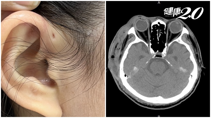 邵雨薇也有的「莫名小洞」醫警示需清潔時別亂擠，有人因此感染險毀半張臉