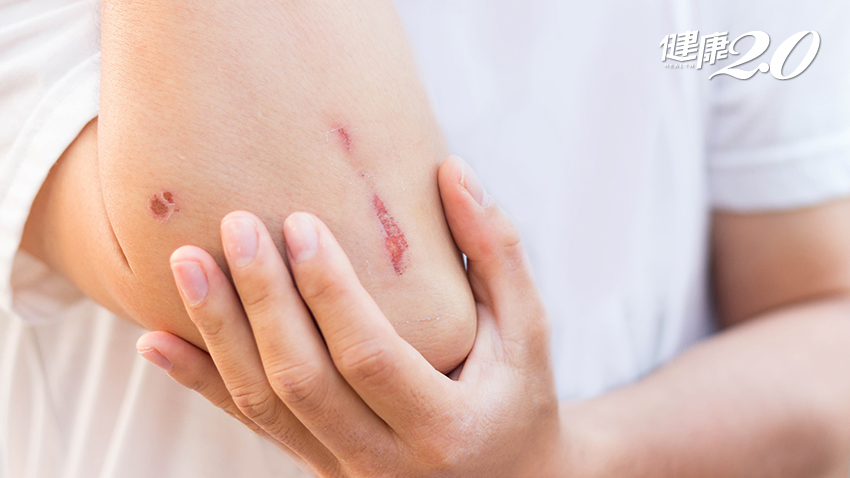 傷口難癒合勿輕忽！出現2徵兆要警覺、嚴重皮膚恐壞死 8高風險族群注意