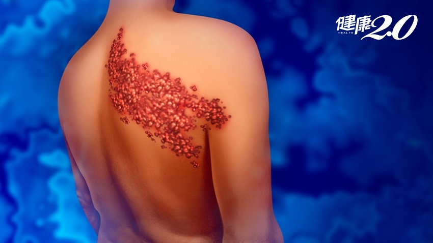 帶狀疱疹發作痛到想自殺，打疫苗可預防！50歲以上可施打，要打2劑 間隔2個月