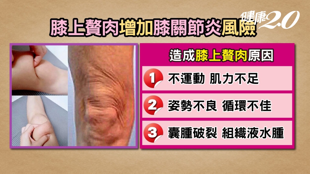 膝蓋上的富貴包恐釀肌無力、關節積水！1動作降46％風險，小心3個動作害你痛！