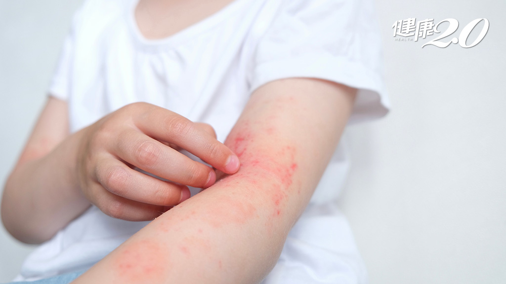 改善異位性皮膚炎！生物製劑8/1起放寬健保給付 中重度患者、12歲以上皆能受惠